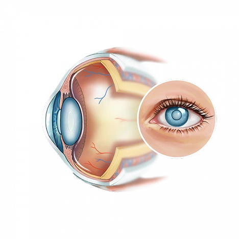 Illustration de la sélection d'implants