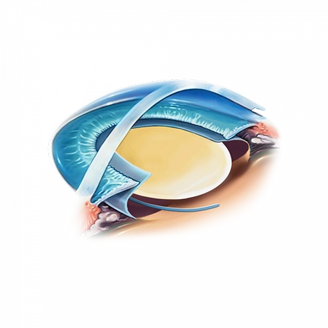 Illustration du choix d'implant sur mesure