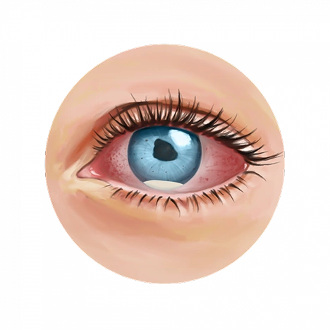 Illustration d'un œil examiné après une chirurgie