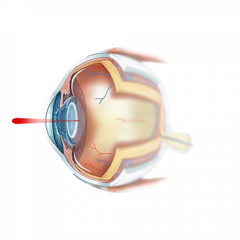 Illustration de la capsulotomie au laser YAG