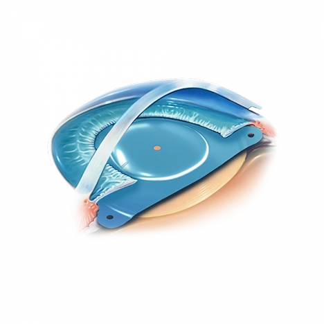 Schéma d'un implant phaque