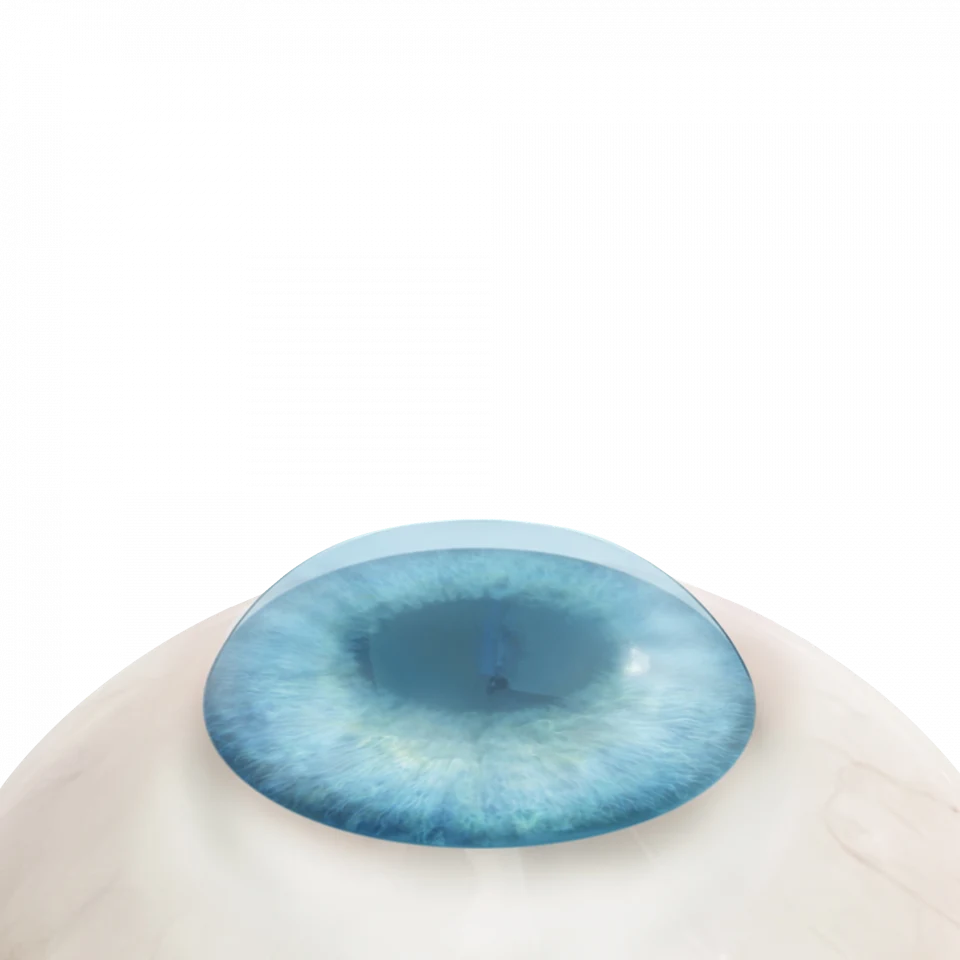 Illustration de la cataracte