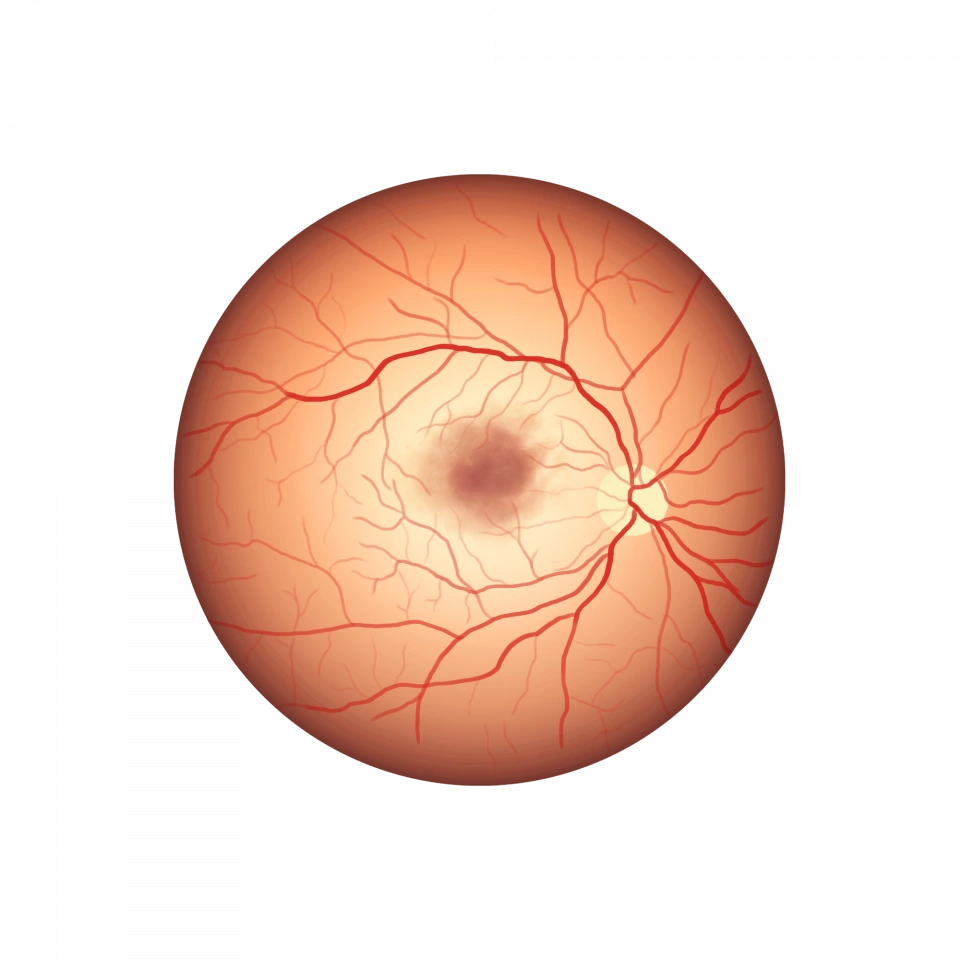 Illustration de la cataracte