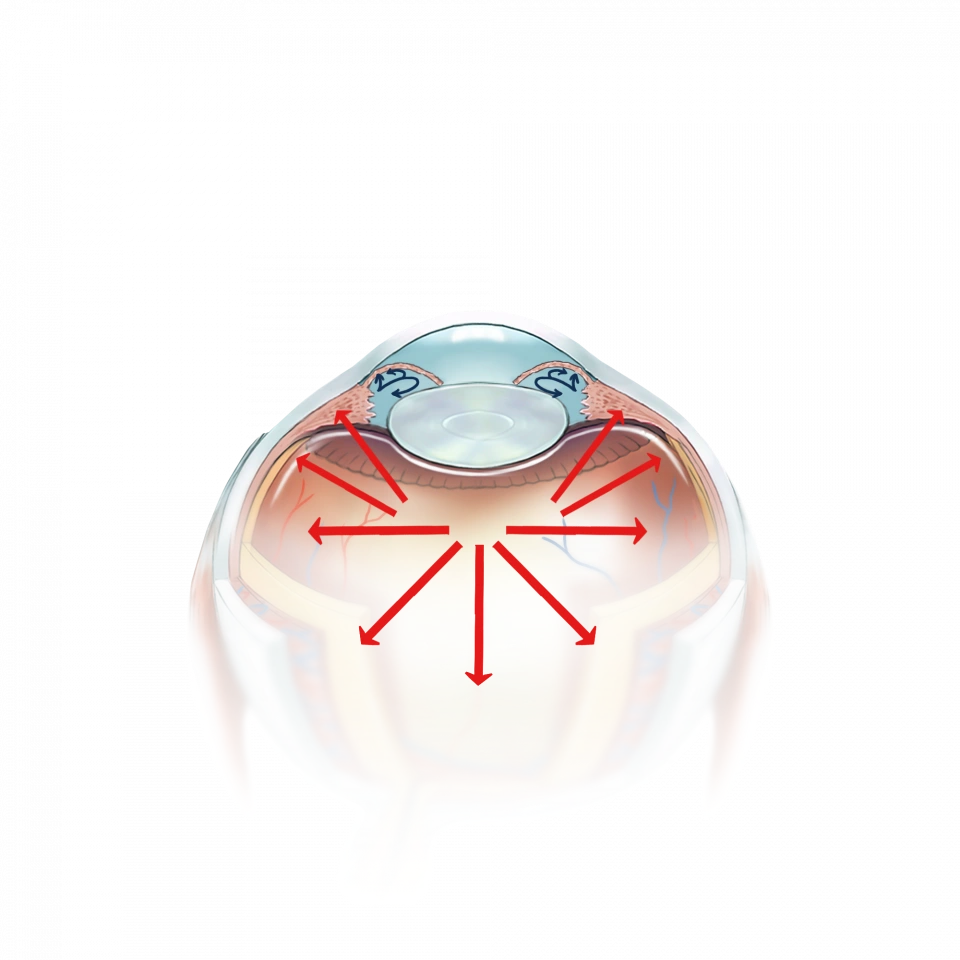Illustration de la cataracte