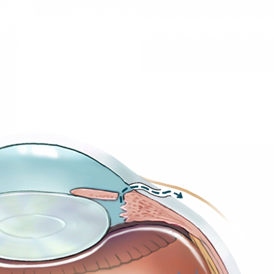 Illustration de la cataracte