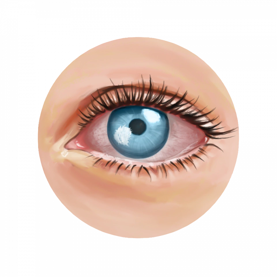 Infection de la cornée liée au port de lentilles