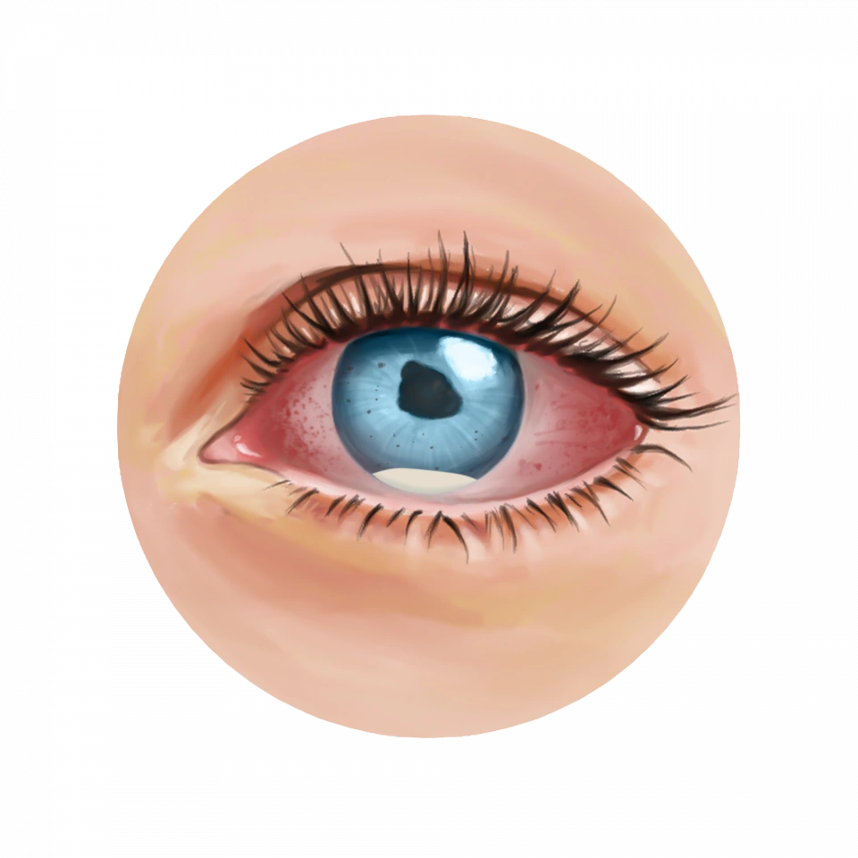 Anatomie des tissus touchés par une uvéite