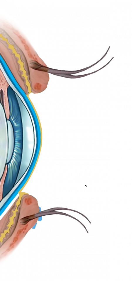 Illustration de la sélection d'implants