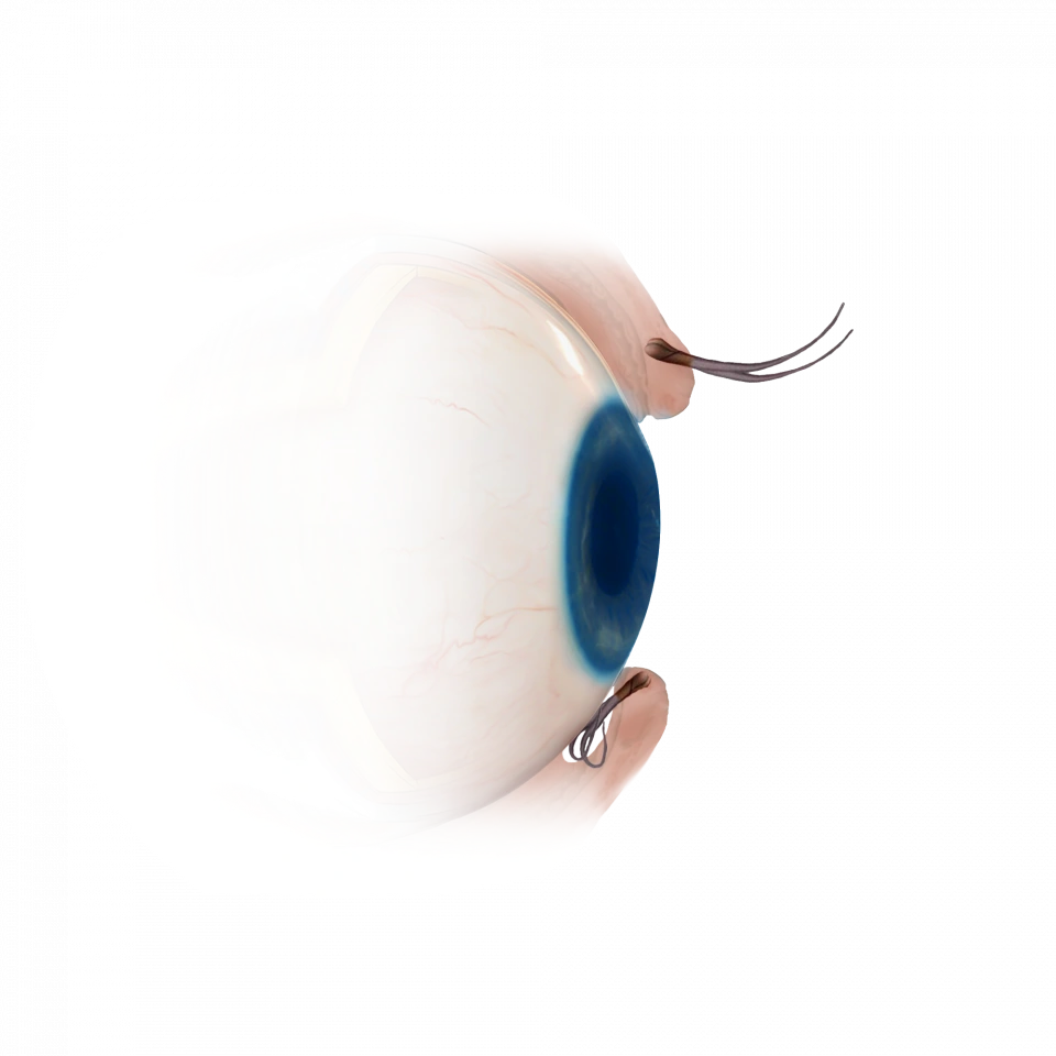 Illustration de la sélection d'implants