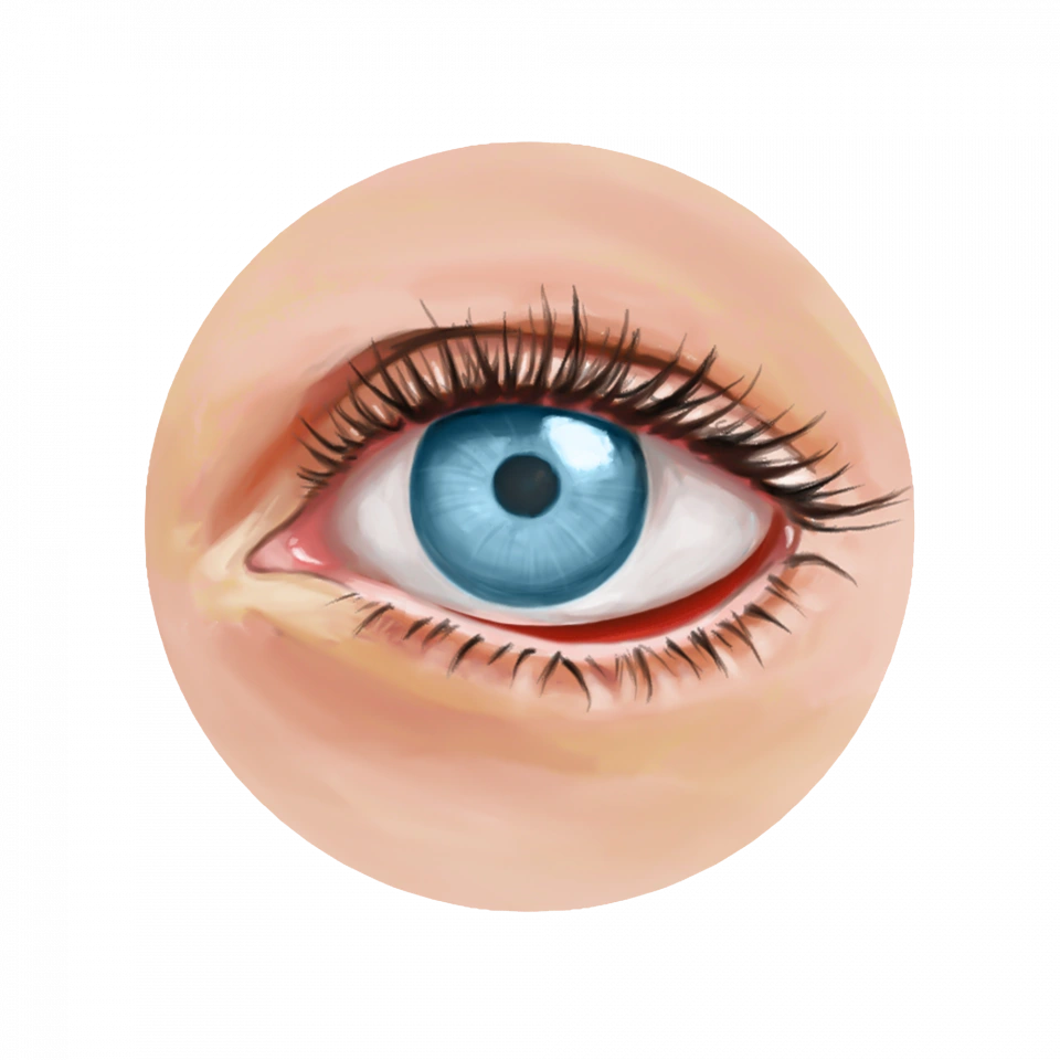 Illustration de la sélection d'implants