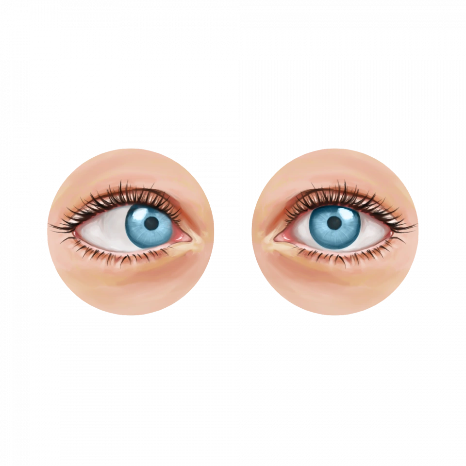Illustration de la cataracte
