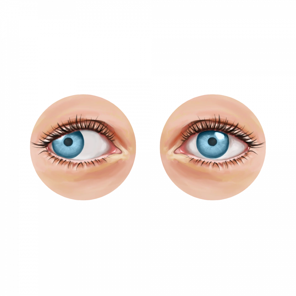 Illustration de la cataracte
