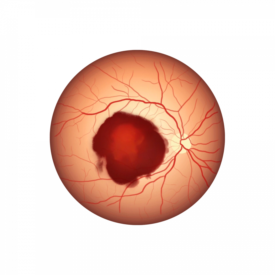 Illustration d'un hématome sous-maculaire