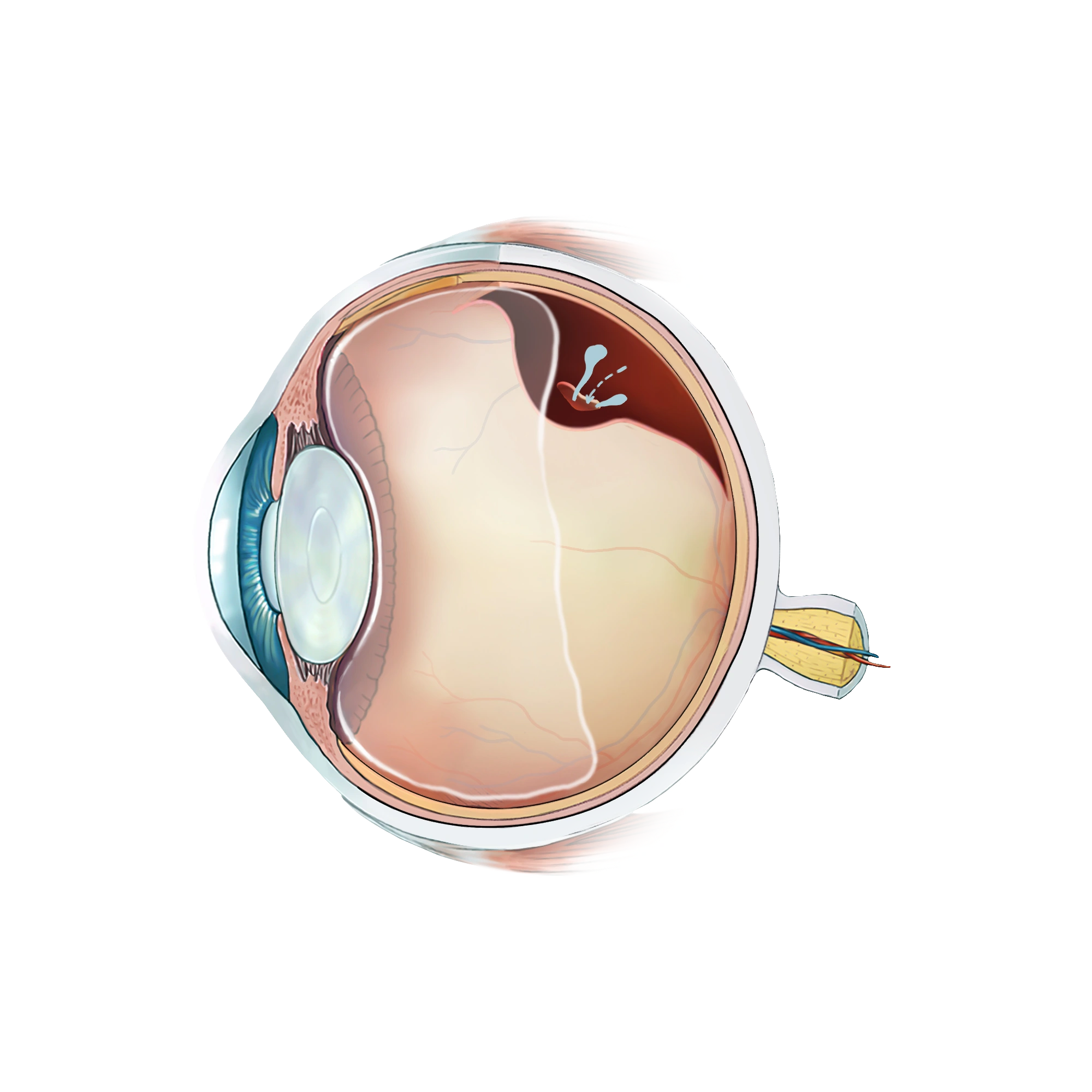 Illustration d'un décollement de rétine