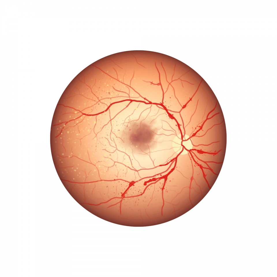 Illustration d'une rétinopathie diabétique