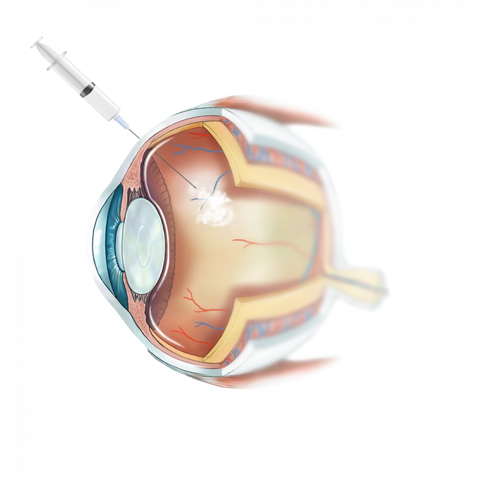 Préparation d'une injection intra-vitréenne